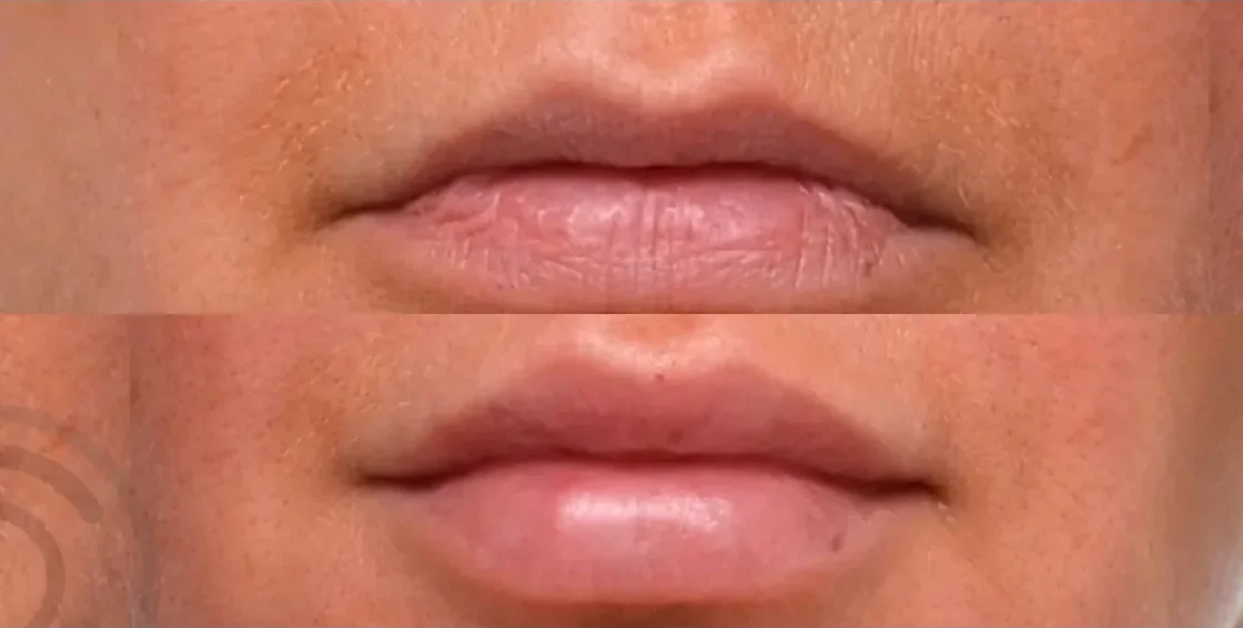 Lip Filler